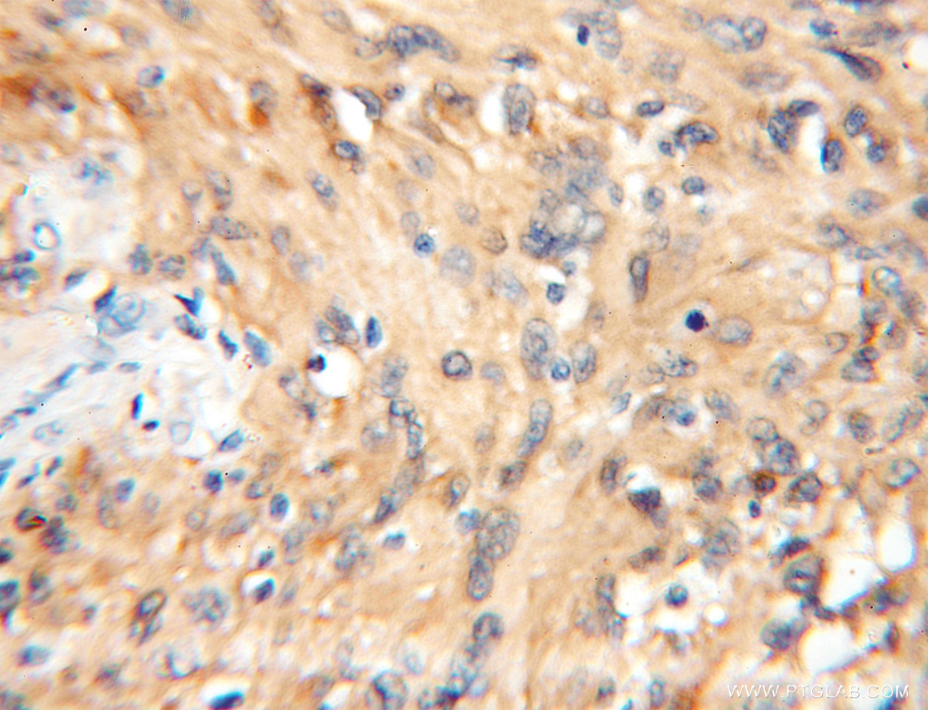 11648-2-AP;human gliomas