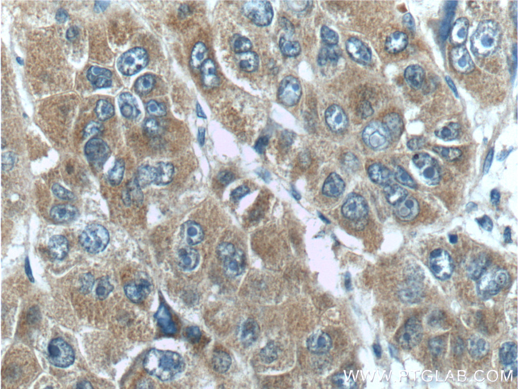 17871-1-AP;human liver cancer tissue
