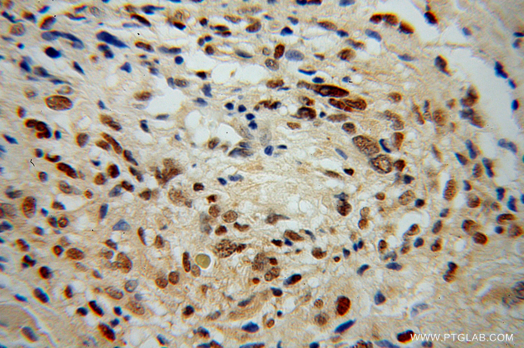 13559-1-AP;Gliomas