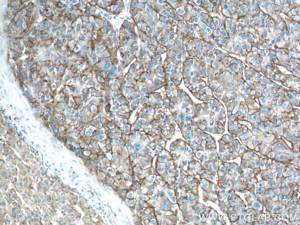 14418-1-AP;human liver cancer tissue