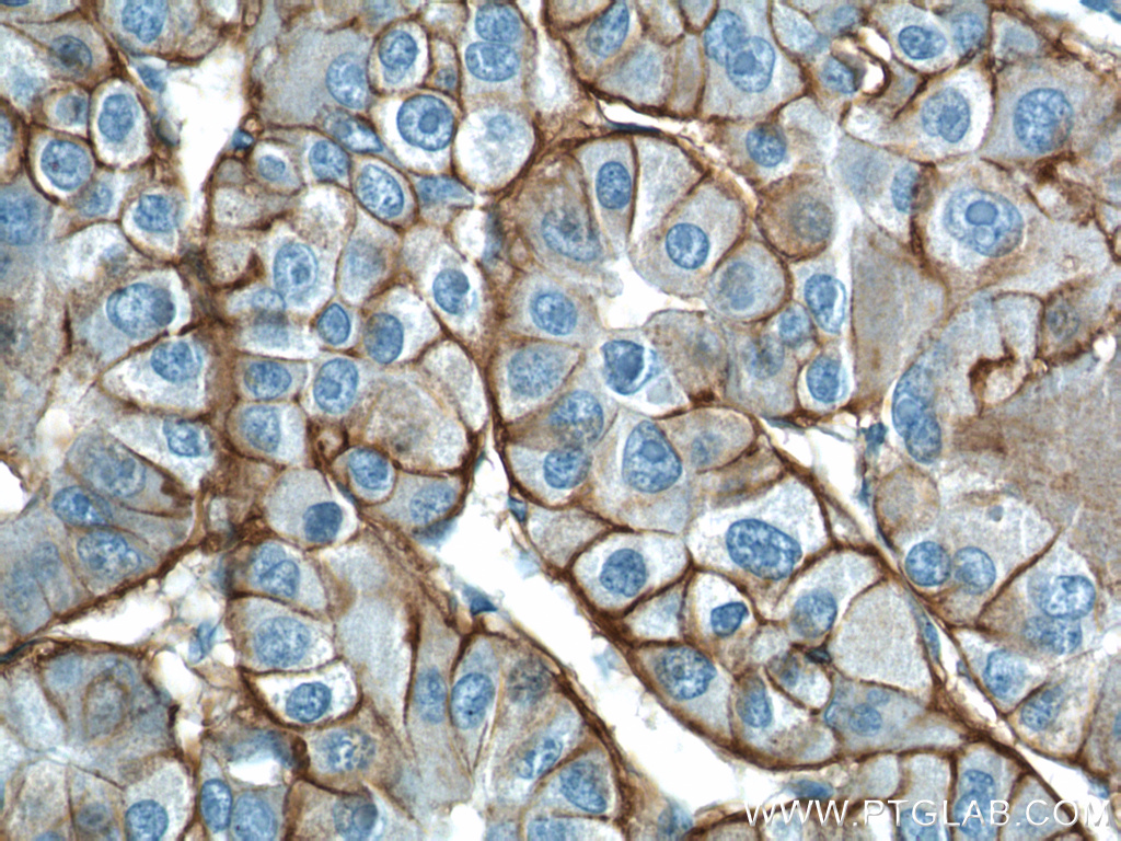 14418-1-AP;human liver cancer tissue