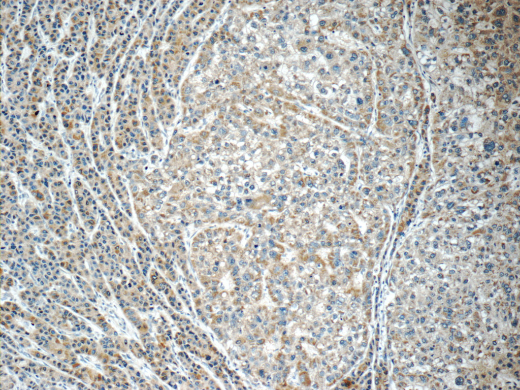 25758-1-AP;human liver cancer tissue