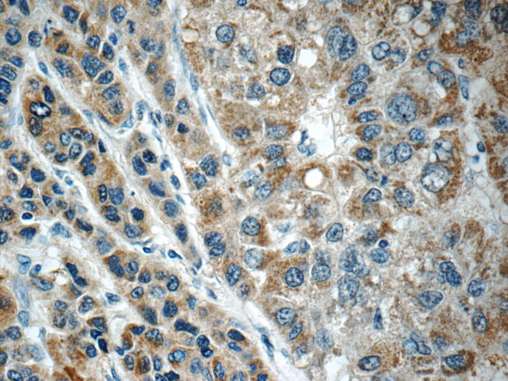 25758-1-AP;human liver cancer tissue