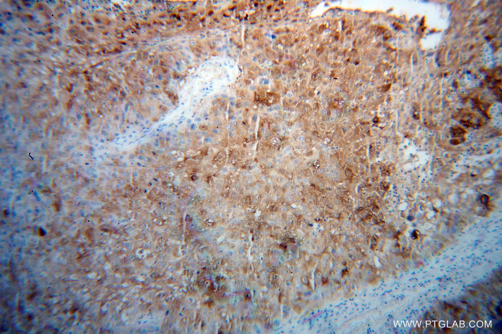 13059-1-AP;Skin Cancer