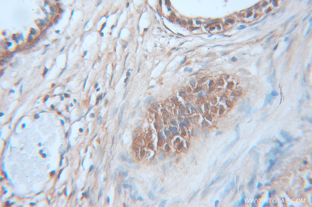 10194-1-AP;Prostate cancer