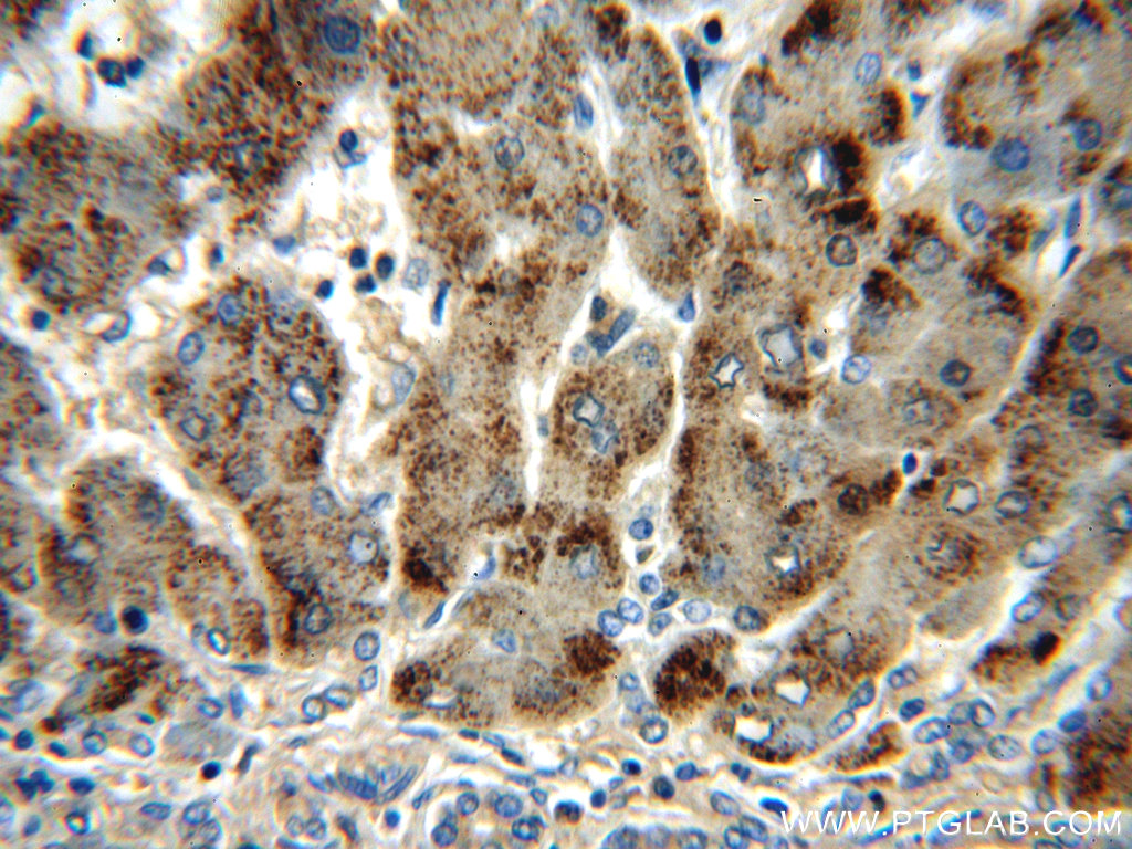 21260-1-AP;human hepatocirrhosis