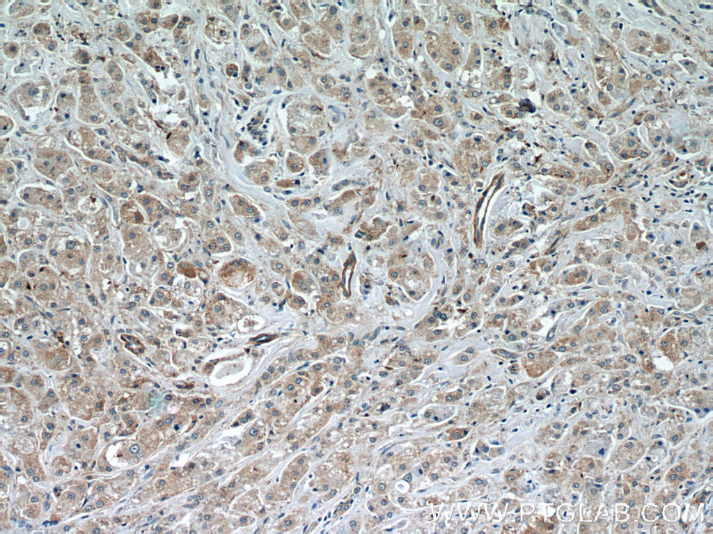 24689-1-AP;human breast cancer tissue