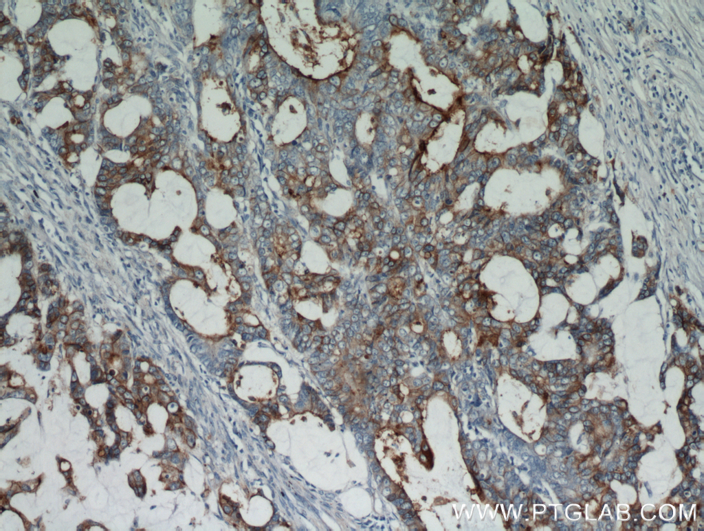 10421-1-AP;human colon cancer tissue