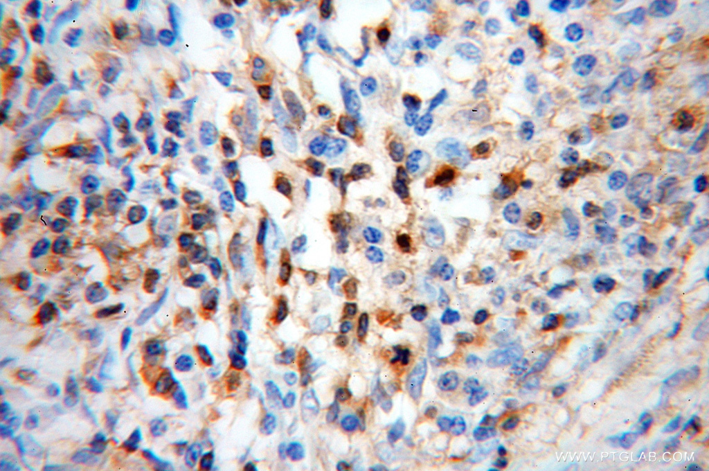 10960-1-AP;human cervical cancer
