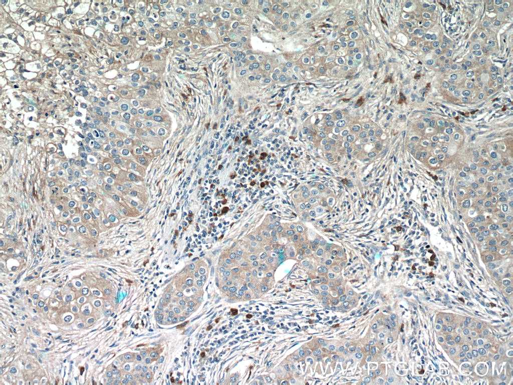 18108-1-AP;human breast cancer tissue