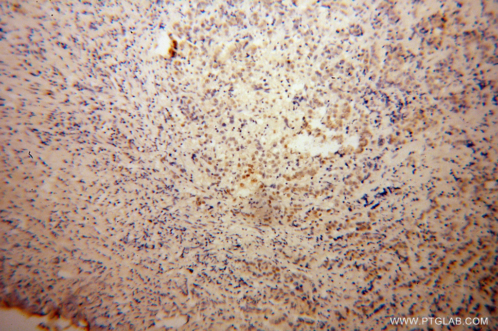 11120-1-AP;Prostate cancer