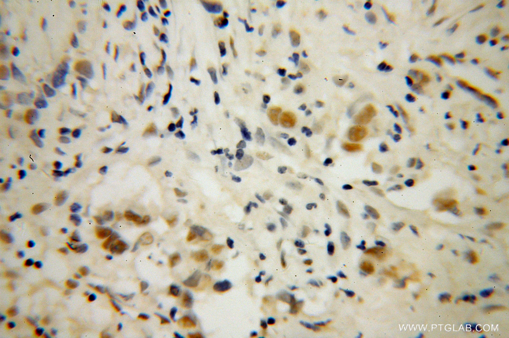 11120-1-AP;Prostate cancer