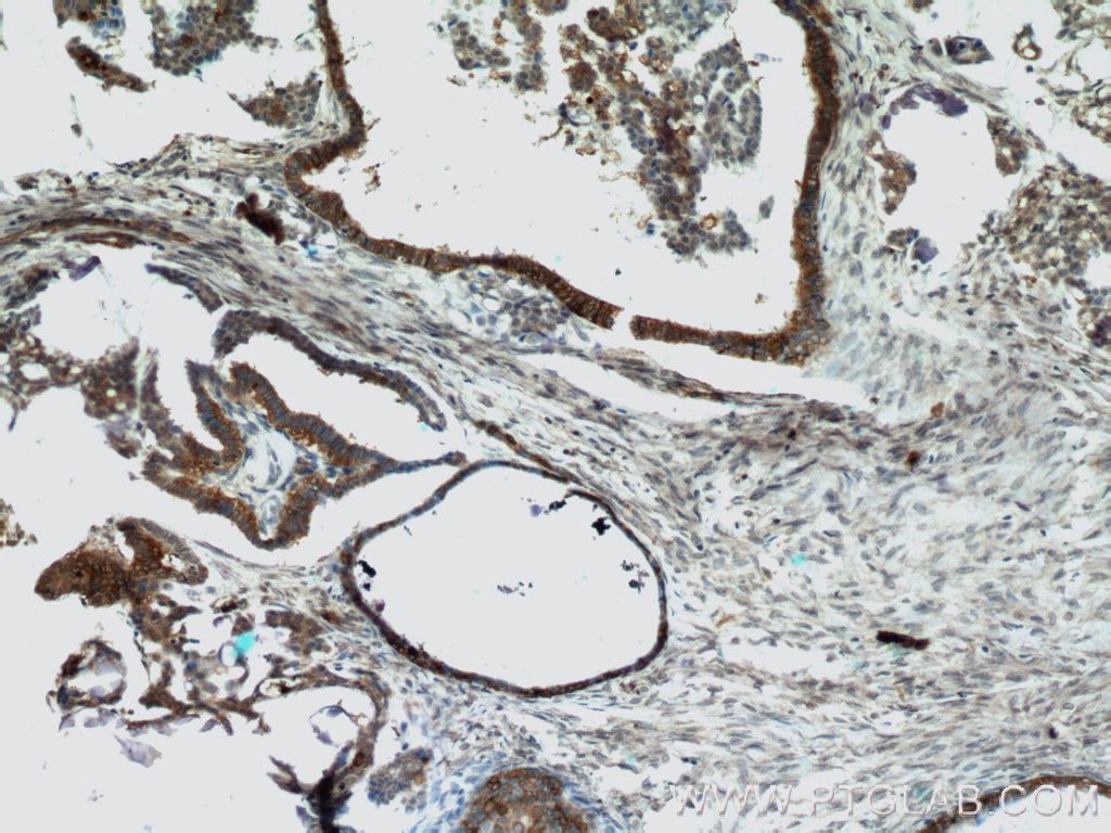 11790-1-AP;human ovary tumor tissue