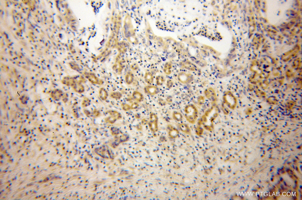 13064-1-AP;Pancreas cancer