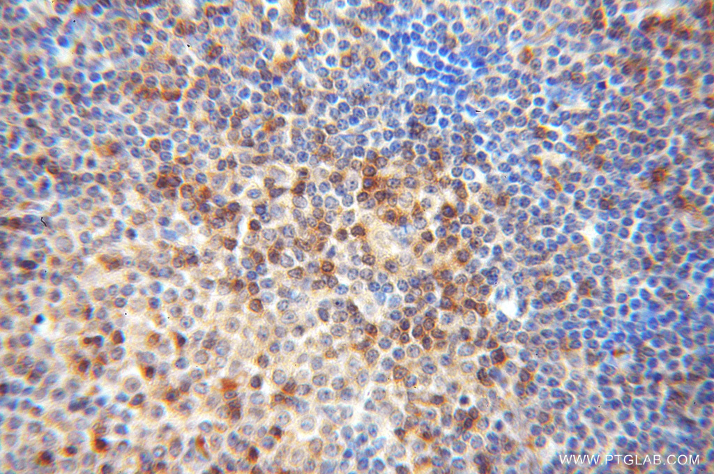 14087-1-AP;Lymphoma