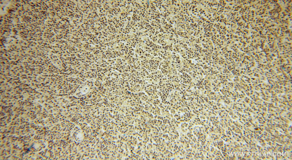 15749-1-AP;Lymphoma
