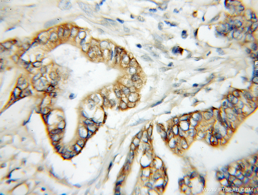 12007-1-AP;Pancreas cancer