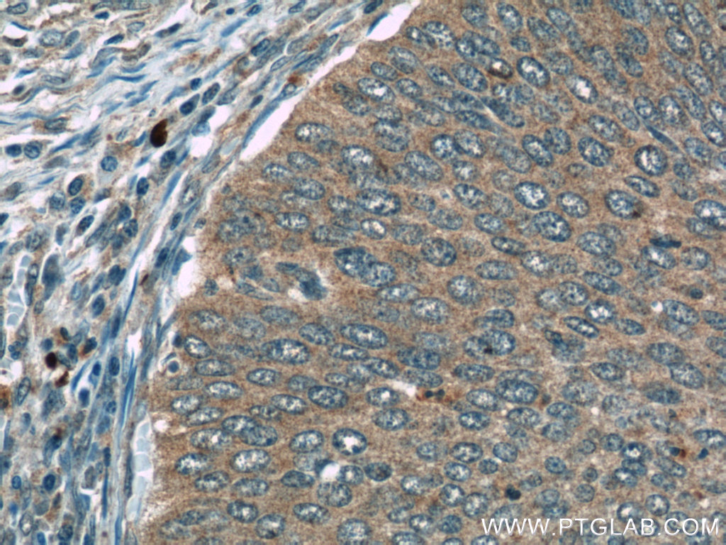 24422-1-AP;human cervical cancer tissue