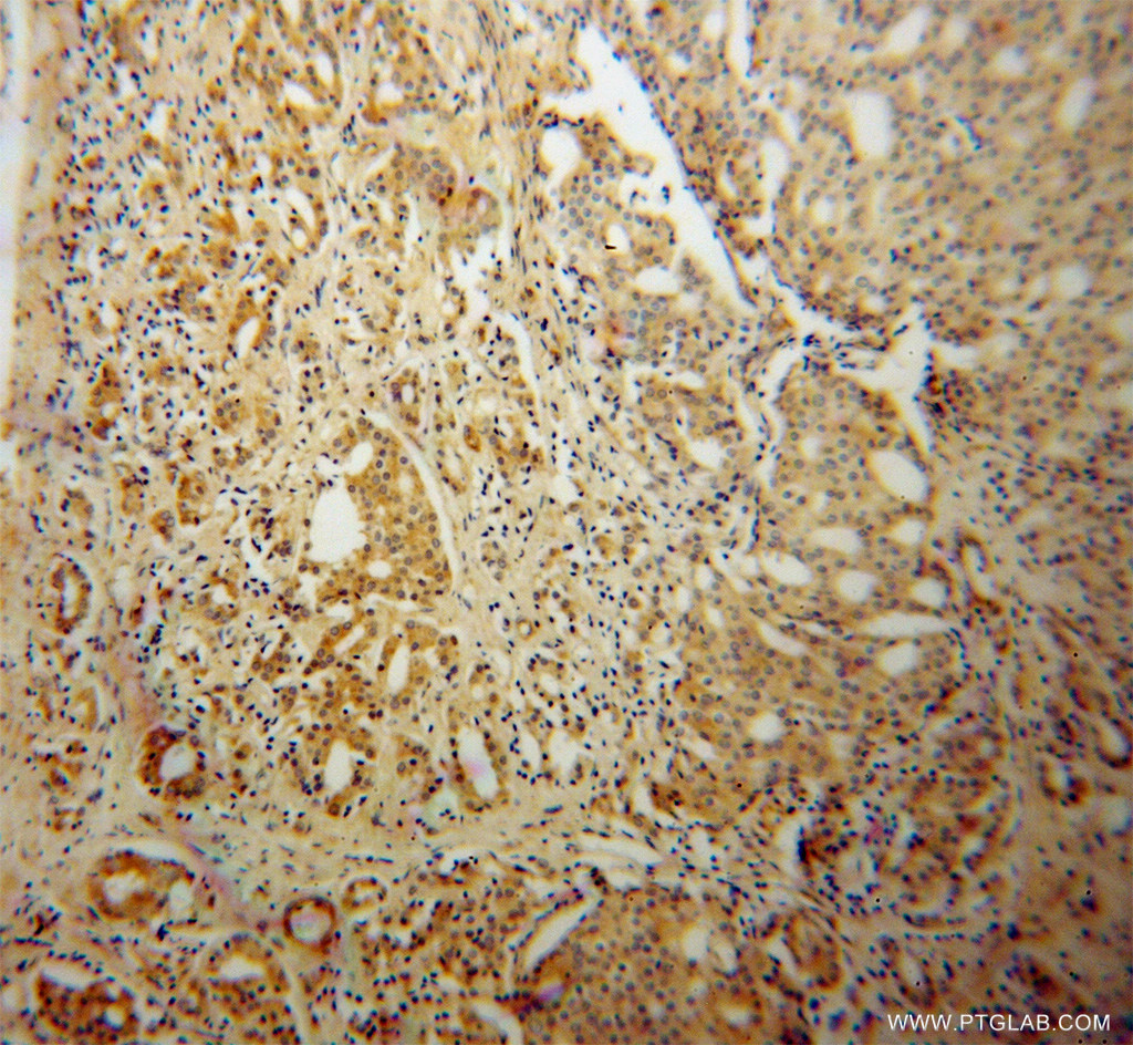 13220-1-AP;human prostate cancer tissue