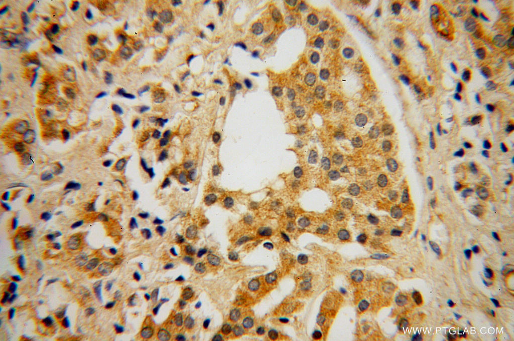 13220-1-AP;human prostate cancer tissue