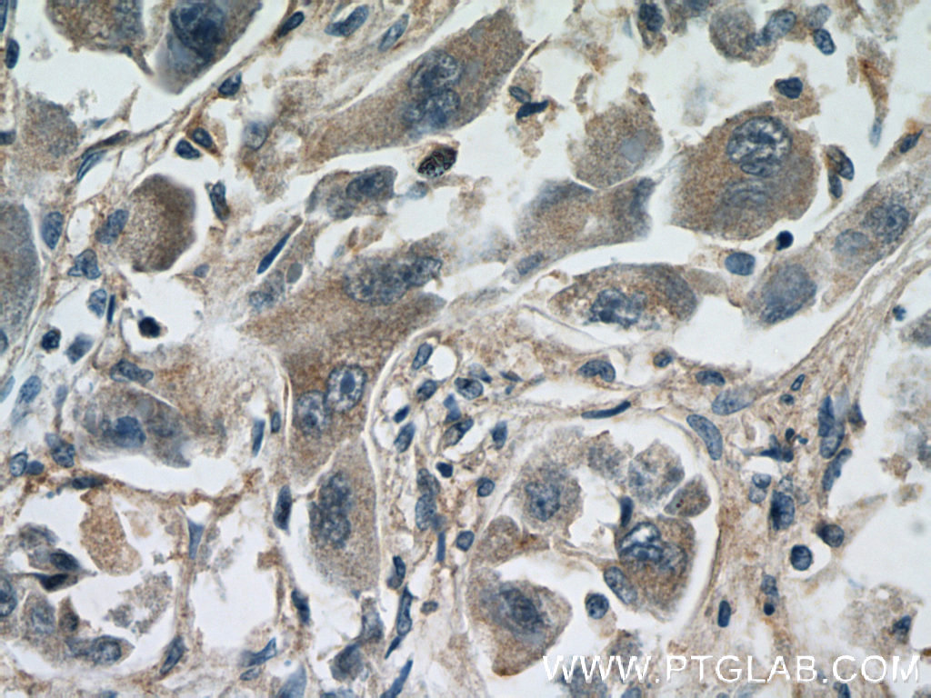 24849-1-AP;human liver cancer tissue