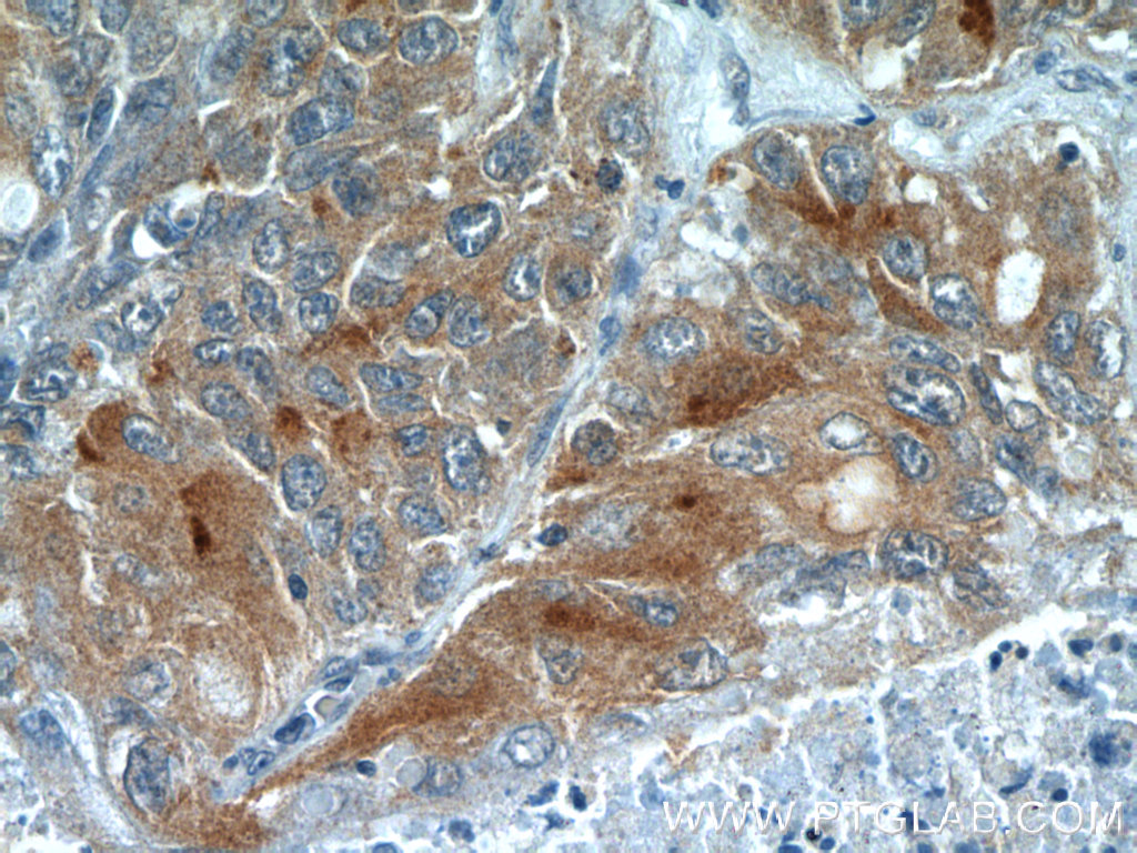 24849-1-AP;human lung cancer tissue
