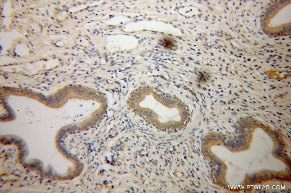 13314-1-AP;Cervical cancer