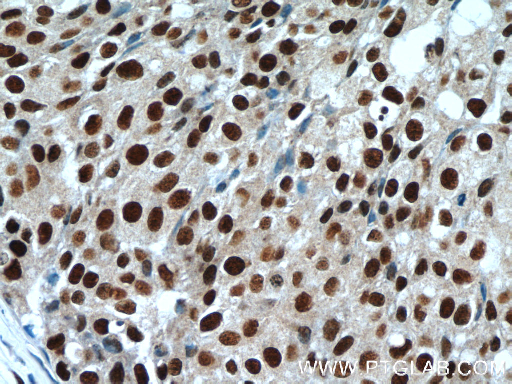 17168-1-AP;human breast cancer tissue