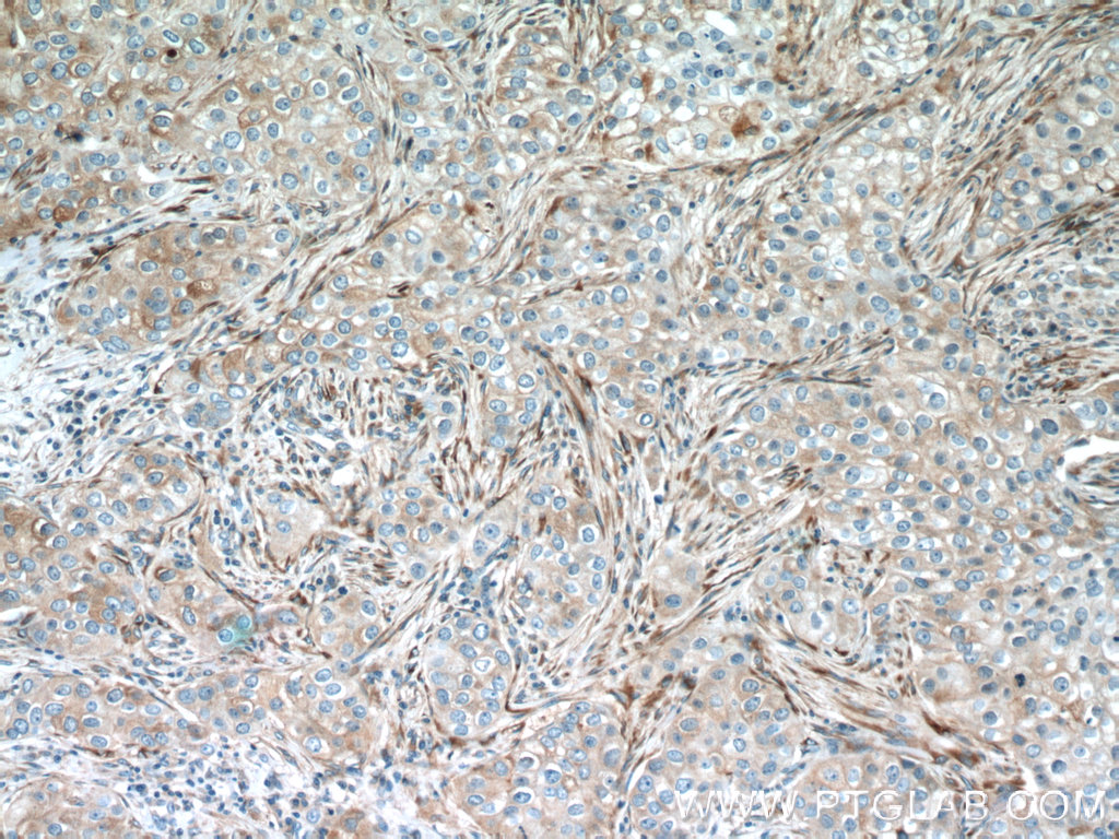 23247-1-AP;human breast cancer