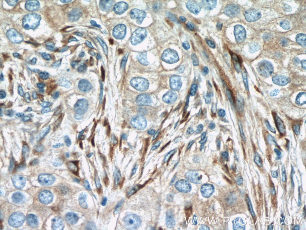 23247-1-AP;human breast cancer