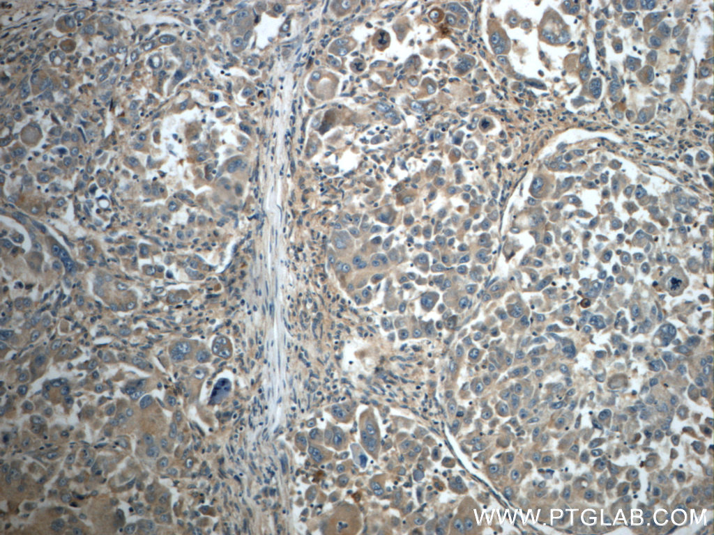 23247-1-AP;human liver cancer