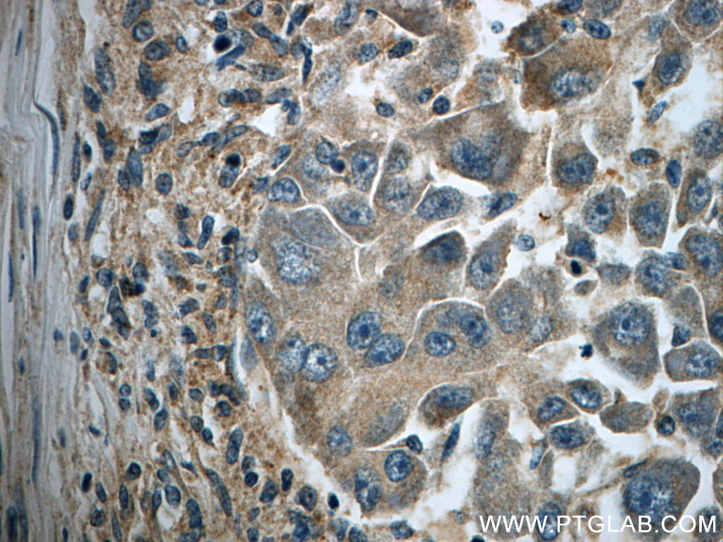 23247-1-AP;human liver cancer