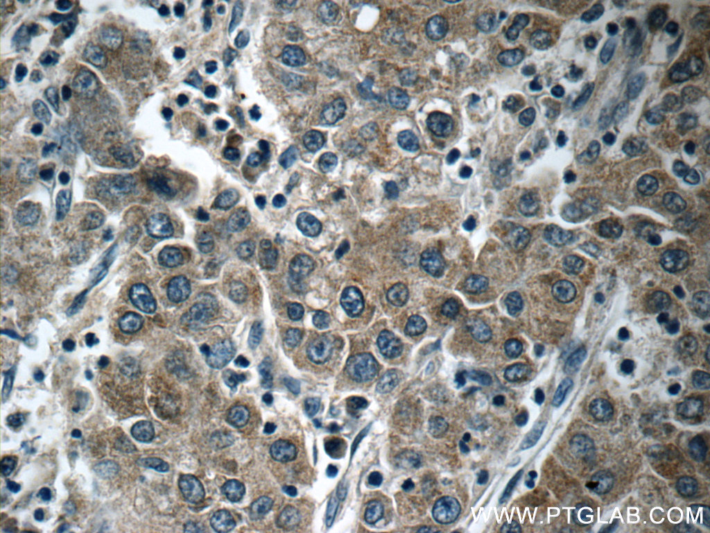 25195-1-AP;human liver cancer tissue