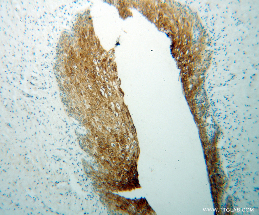 13403-1-AP;Cervical cancer