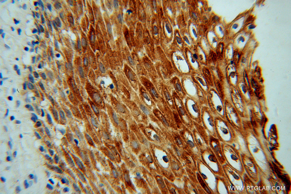 13403-1-AP;Cervical cancer