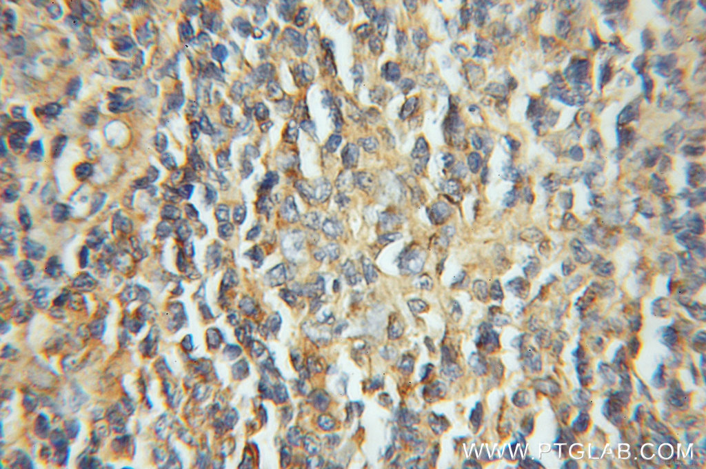11577-1-AP;human lymphoma
