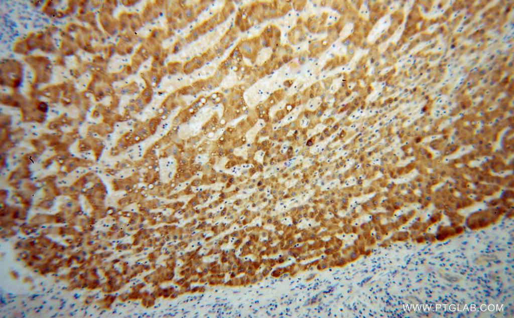 15103-1-AP;Liver cancer