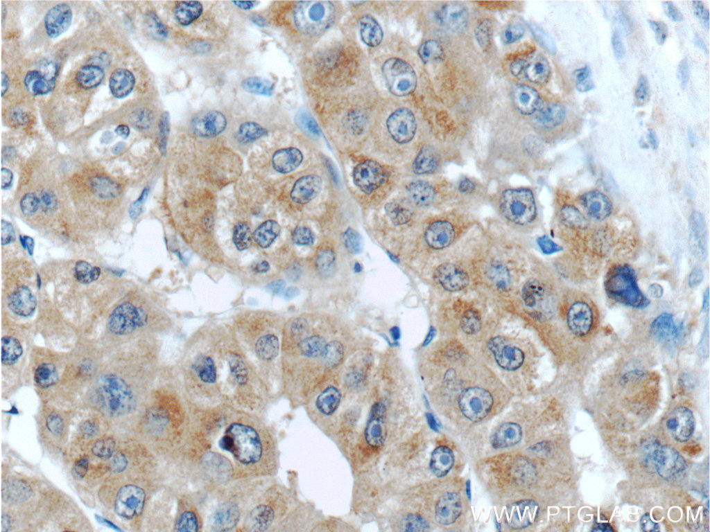20579-1-AP;human liver cancer tissue