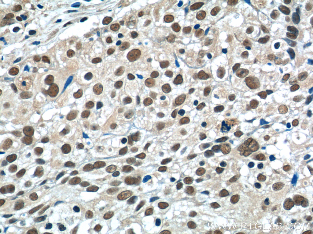 20579-1-AP;human lung cancer tissue