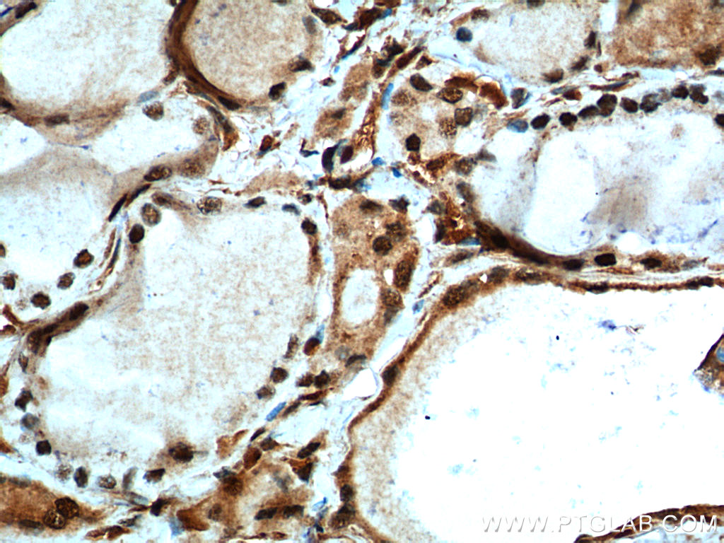 10159-2-AP;human thyroid cancer tissue