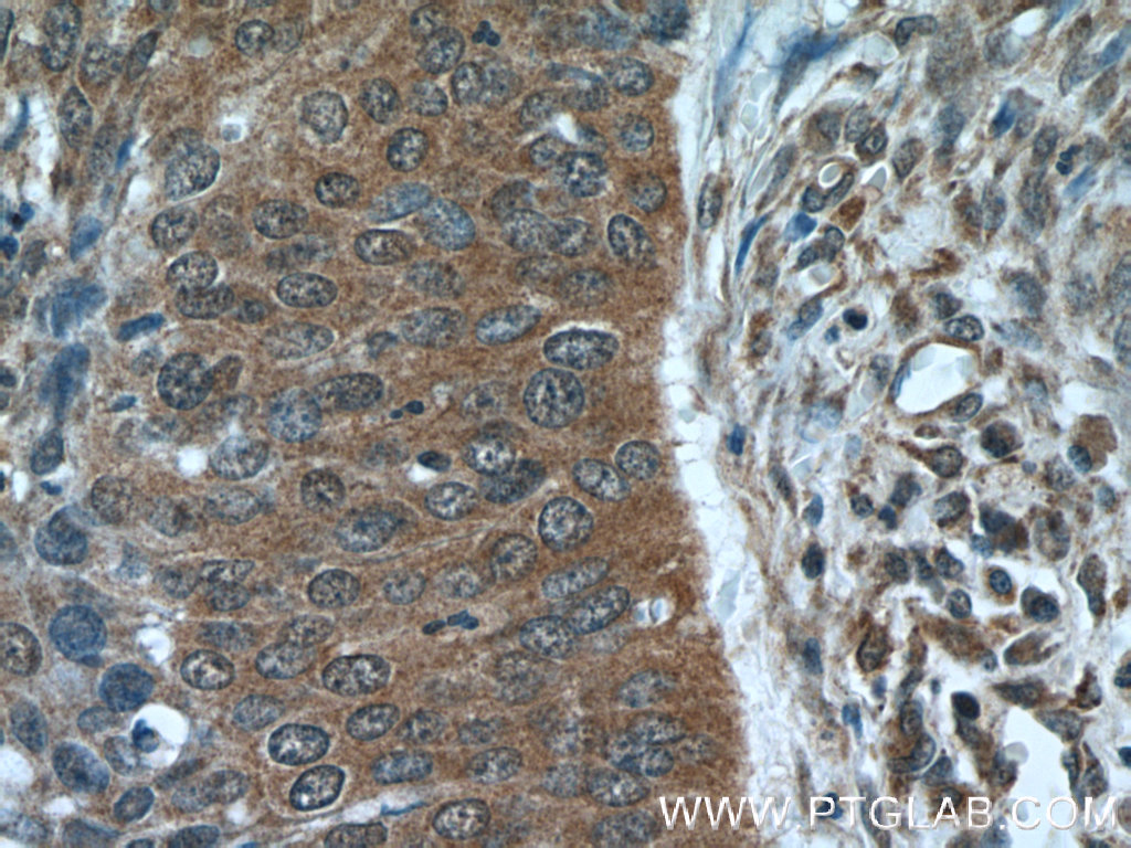 24563-1-AP;human cervical cancer tissue