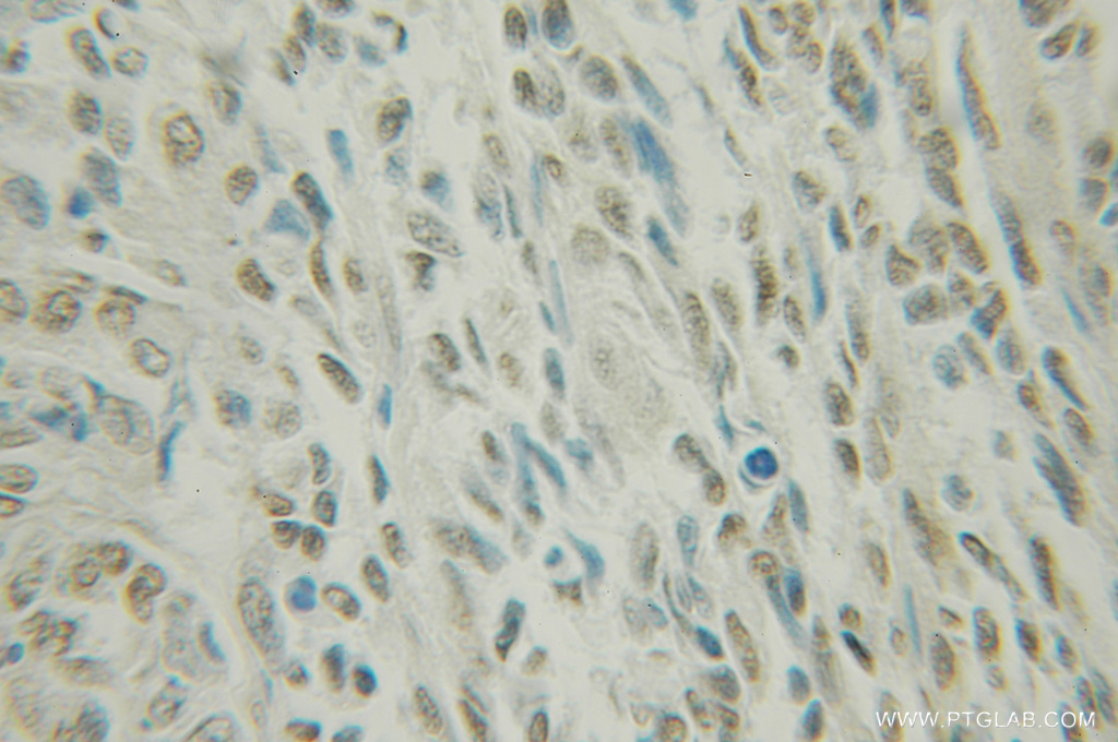 12515-1-AP;human ovary tumor