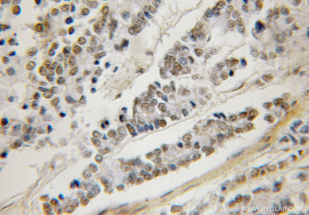 12405-1-AP;human colon cancer