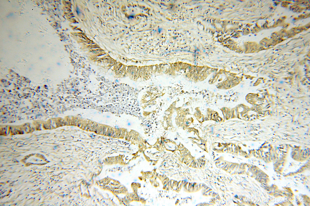 10837-1-AP;human pancreas cancer