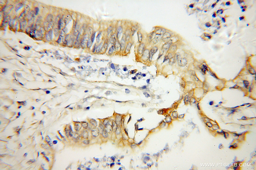 10837-1-AP;human pancreas cancer