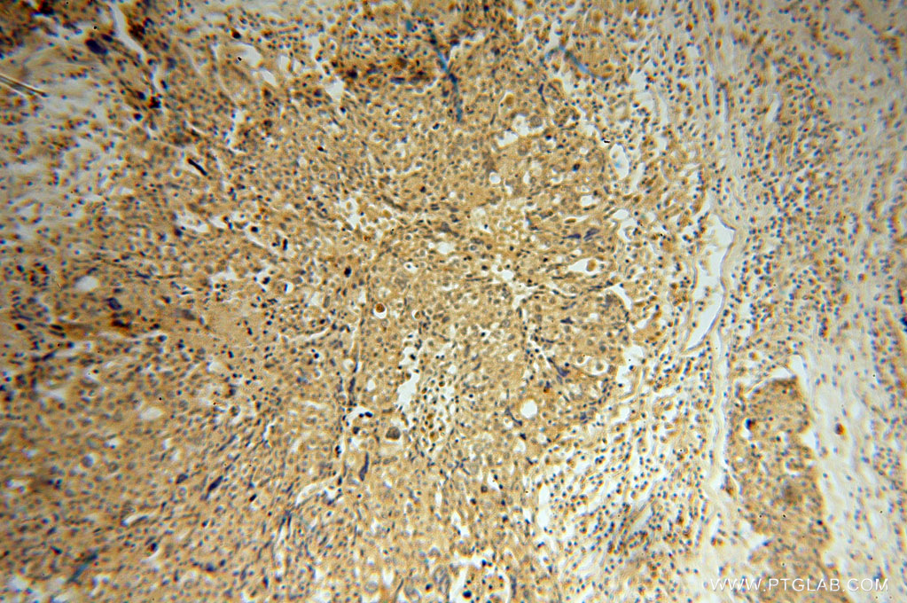 15702-1-AP;Ovary tumor