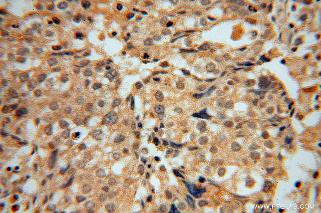 15702-1-AP;Ovary tumor