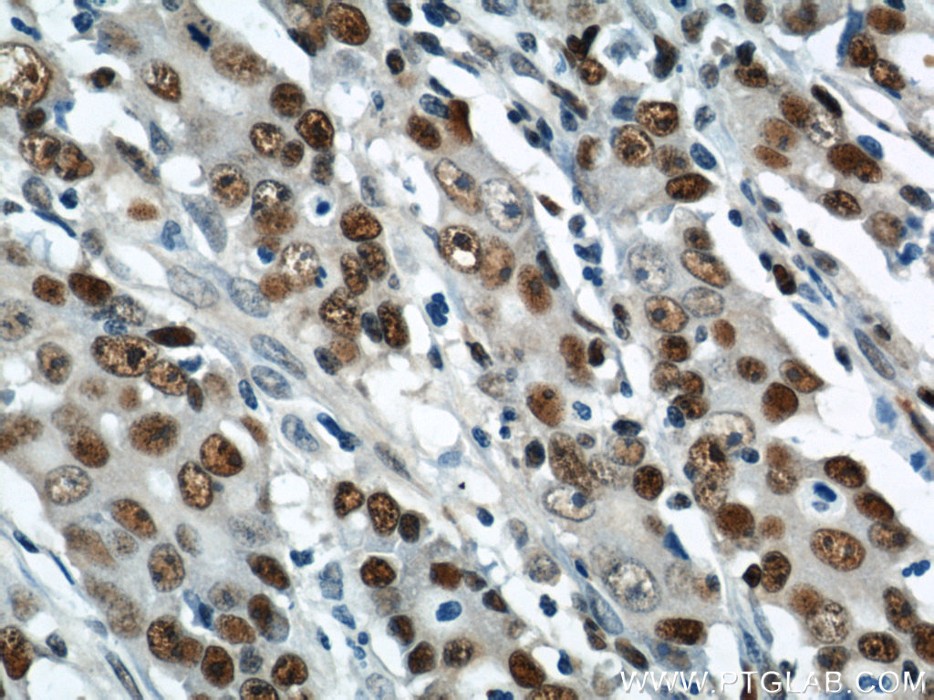 10205-2-AP;human stomach cancer tissue