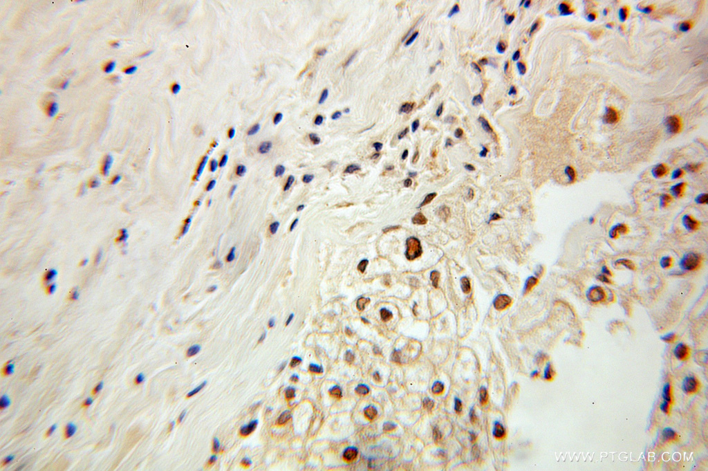 10725-1-AP;Ovary tumor