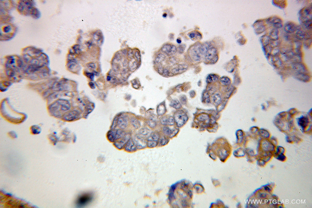 10221-1-AP;human ovary tumor